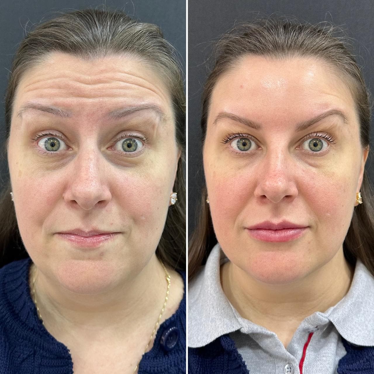 Antes e depois de toxina botulínica