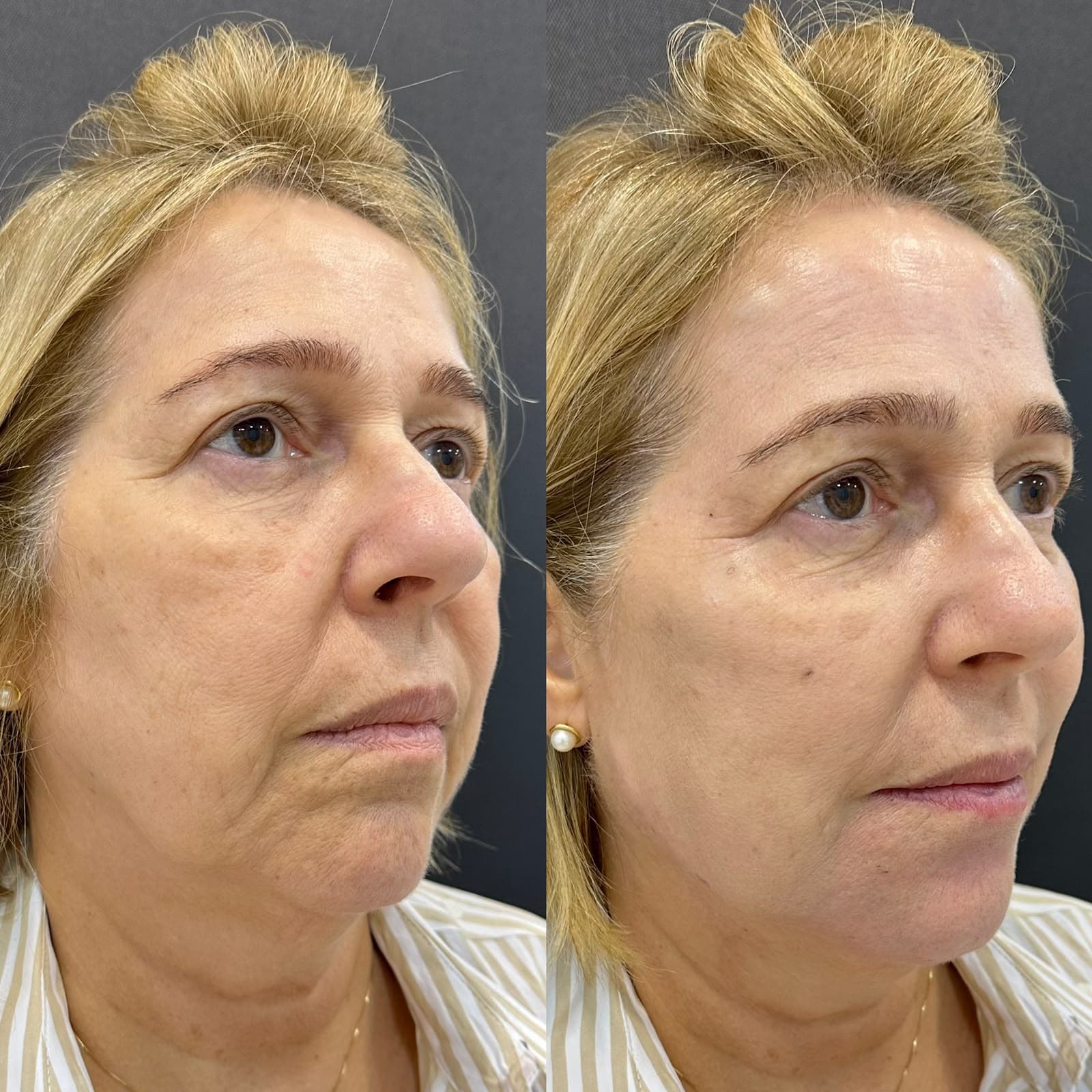Antes e depois de tratamento na região dos olhos