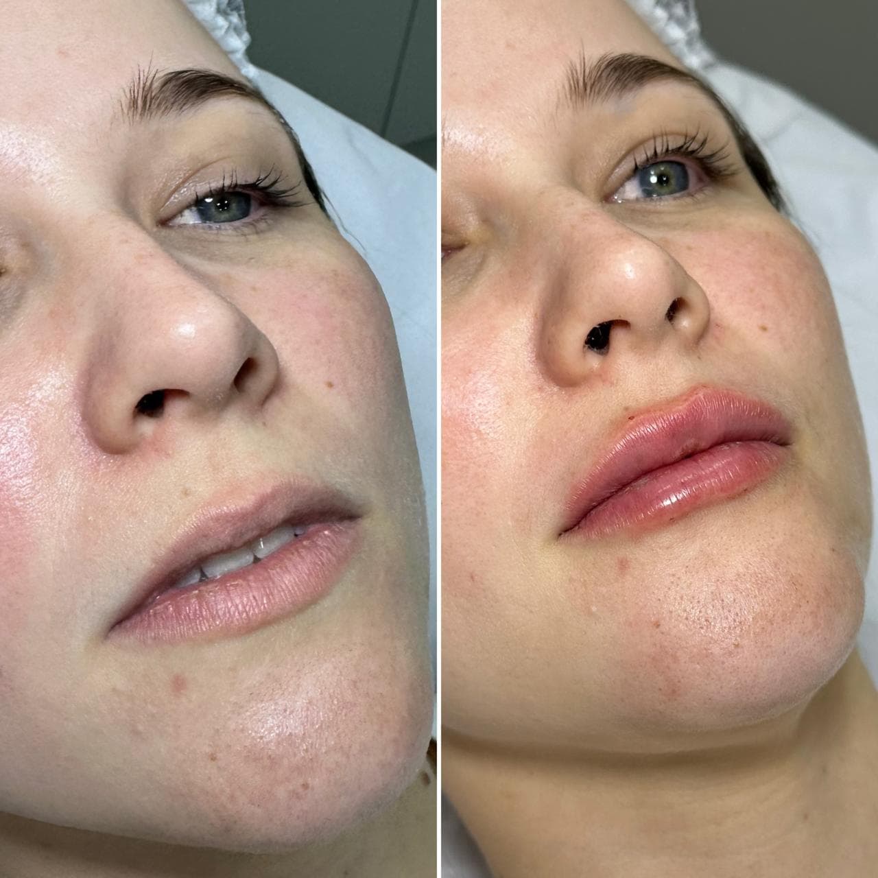 Antes e depois de preenchimento labial
